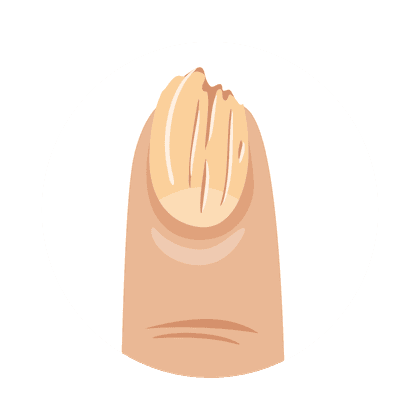 Onycholysis (nail plate detachment)